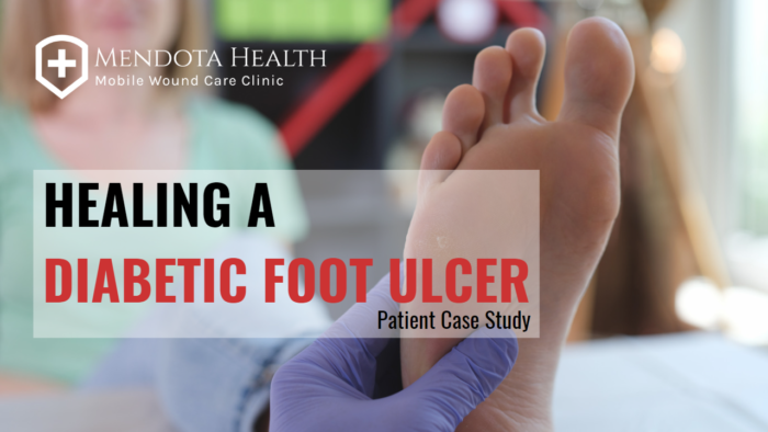 Healing a Diabetic Foot Ulcer - Mendota Health