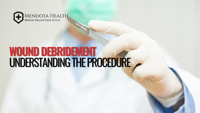 wound-debridement-understanding-the-procedure-mendota-health