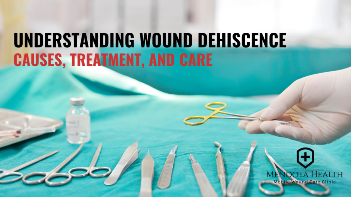 Understanding Wound Dehiscence - Mendota Health