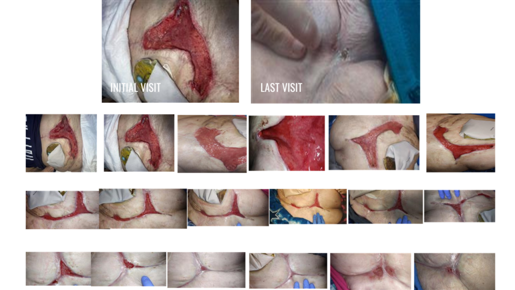 Images of healing progression of a chronic post-surgical wound.